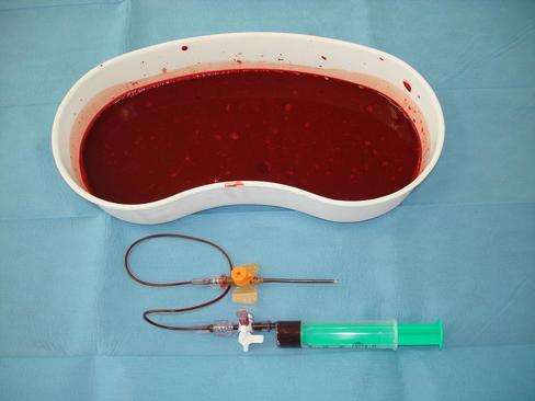 Hemoperikard-odsátá krev