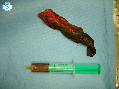 Žlučový měchýř a peritoneální efuze