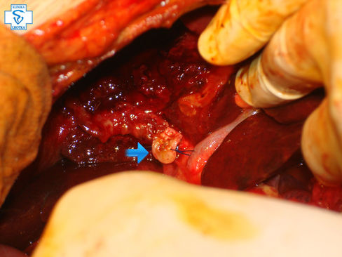 Cholecystektomie-podvaz krčku žlučníku2