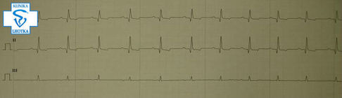 EKG-normální nález