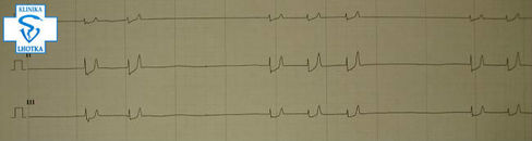 EKG-hyperkalemie