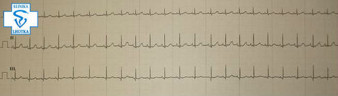 EKG-normalizace po úpravě hyperkalemie